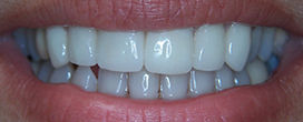 The image shows a close-up of a person s smile with white teeth, against a blurred background.