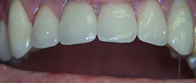 The image shows a close-up of a person s teeth with a focus on dental work, specifically a large gap between the front teeth.