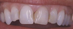 An image showing a close-up view of a person s teeth with a focus on dental health, specifically highlighting yellowing and staining on the teeth.