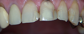 An extreme close-up of a person s teeth with visible stains and yellowing, showcasing poor oral hygiene.