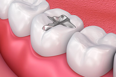 The image shows a close-up view of a human tooth with an implanted silver crown, placed within a dental arch with other teeth and gum tissue visible.