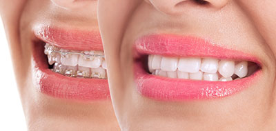 The image shows a person with a wide smile, displaying their teeth against a white background.