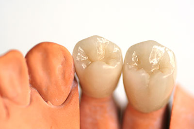 The image displays a set of artificial teeth with visible dental implants positioned next to each other against a white background.