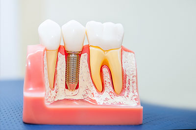 The image displays a set of teeth with artificial roots, showcasing dental implant technology.