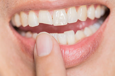 The image shows a close-up of a person s teeth with a focus on a dental implant being placed, with the individual holding their finger over their mouth, smiling broadly, and looking directly at the camera.