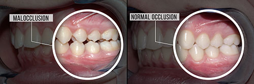 The image shows a side-by-side comparison of two sets of teeth with annotations highlighting different dental issues, including normal occlusion and malocclusion.