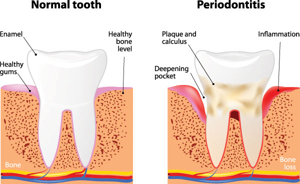 The image shows a step-by-step diagram illustrating the process of tooth decay, from normal teeth to a severely damaged tooth with gum inflammation and bone loss, highlighting the stages of periodontitis.