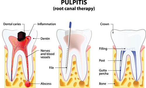 The image shows a scientific illustration of the human mouth with teeth and gums, labeled with medical terms such as  root canal therapy  and  dental caries,  accompanied by annotations explaining the process of dental care, including tooth extraction, filling, and post-treatment care.