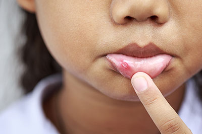 The image shows a close-up of a person s face with a visible skin condition on their lips and chin, with one hand touching the affected area.