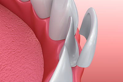 The image shows a close-up view of a dental implant being inserted into a jaw with a pink gum, featuring a metallic screw and an abutment piece.