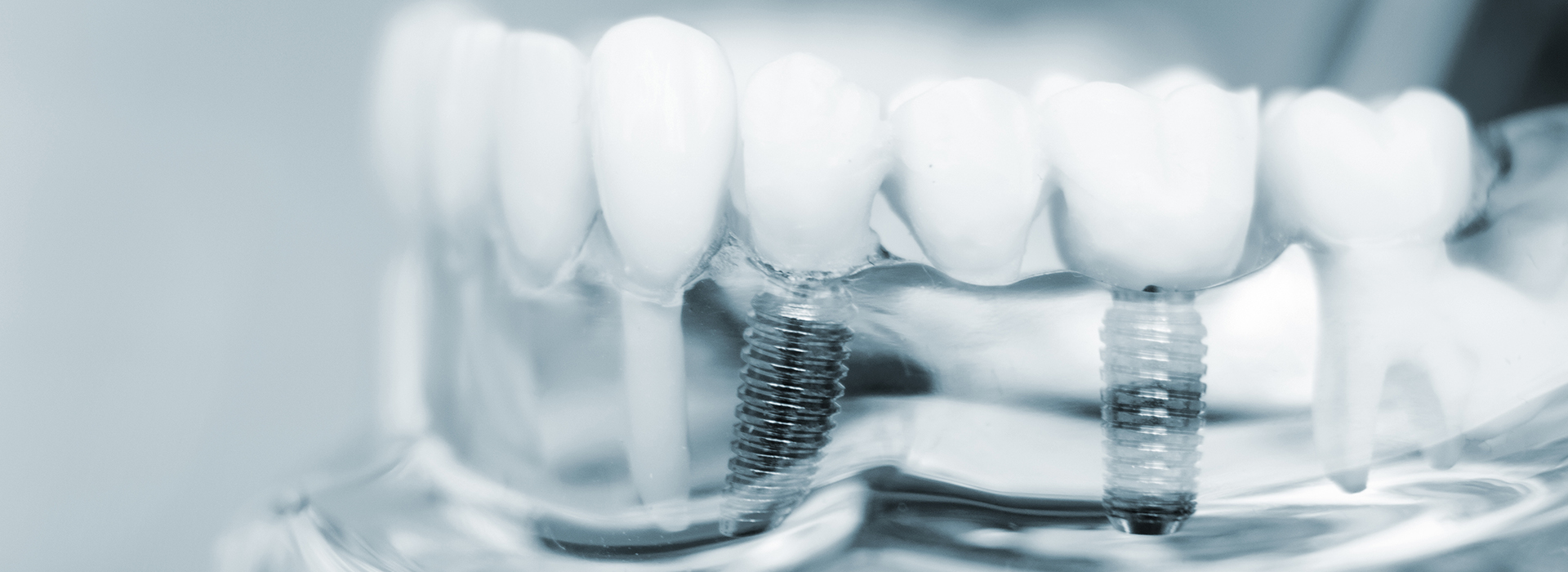 The image shows a close-up view of a dental implant with screws and a transparent protective cover.