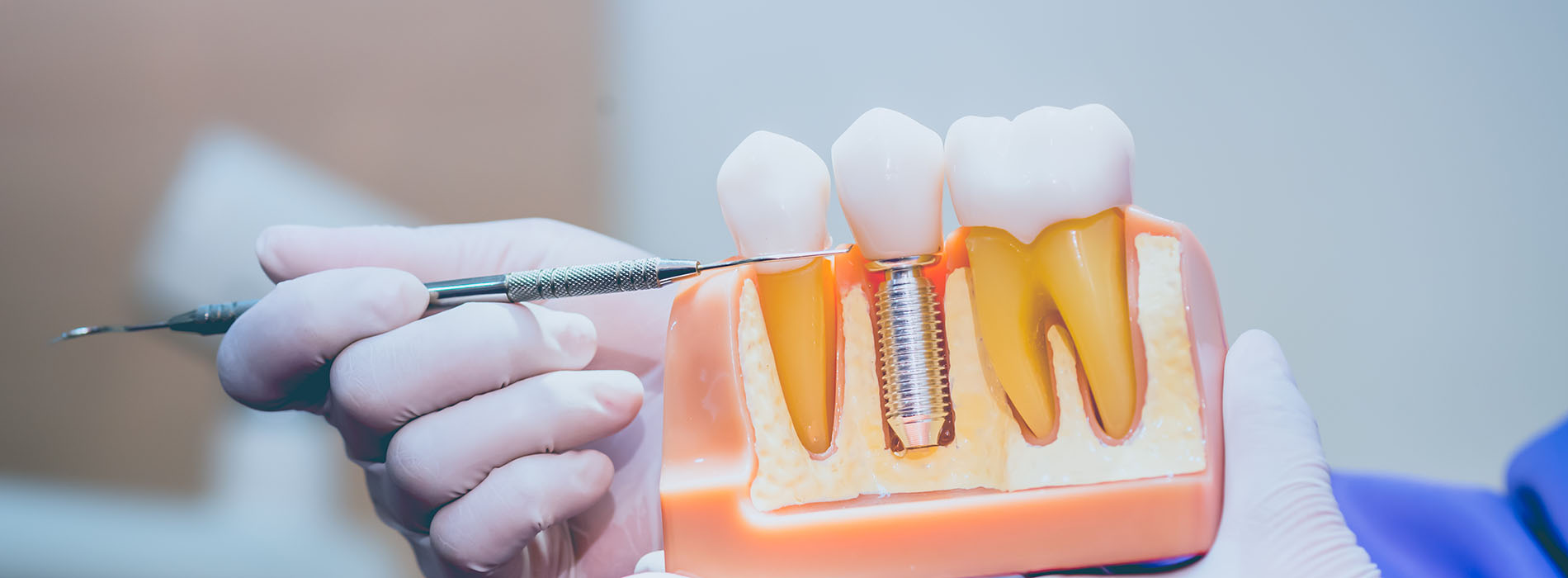 The image shows a person holding a dental implant tool with an implant attached to it, suggesting the process of dental implantation.