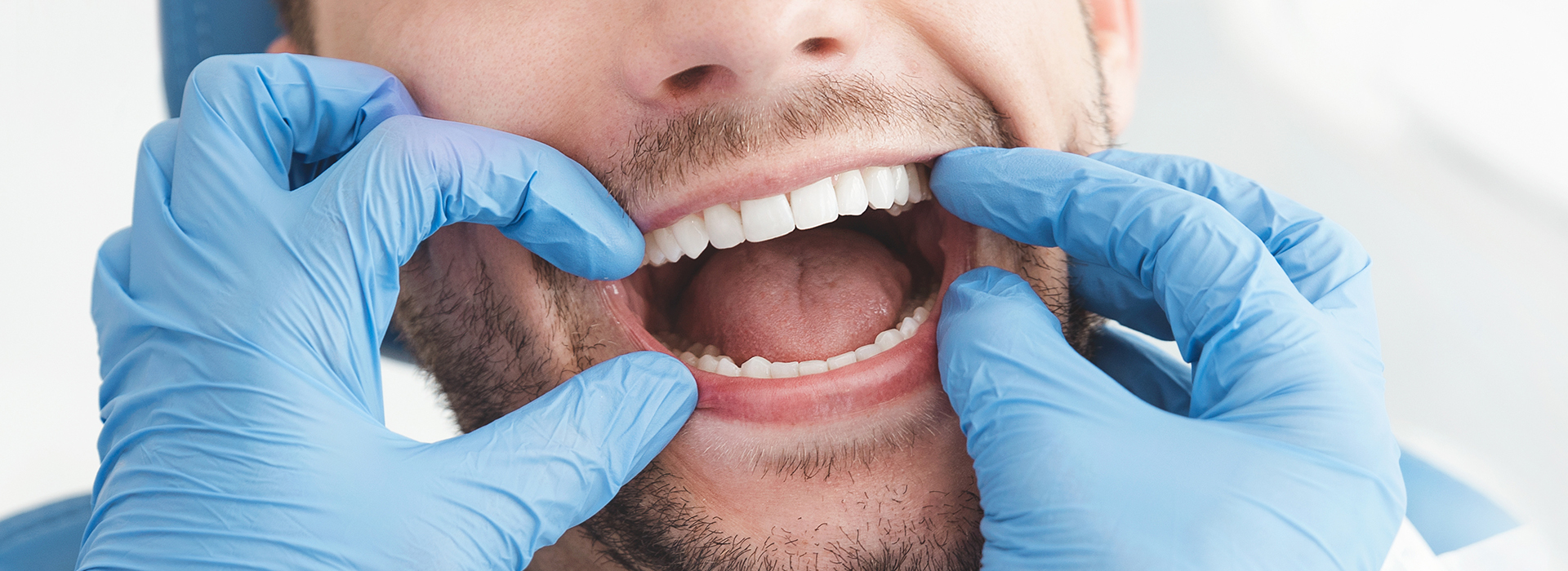 A man wearing blue gloves holds his mouth open, revealing a large gap between his teeth, with a dental mirror reflecting his face.