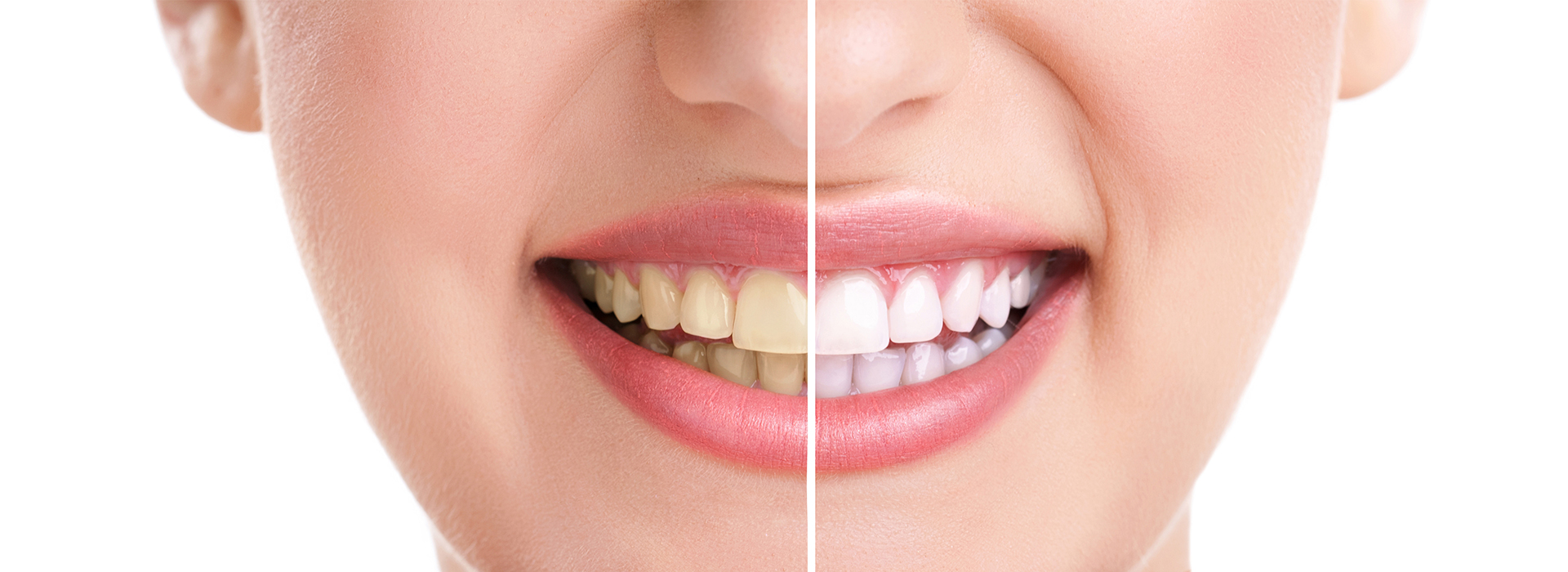 The image shows a close-up of a person s face with a large smile, highlighting their teeth through a contrasting background.