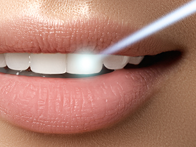 The image features a close-up view of a person s lips with a focus on the teeth, set against a blurred background, likely for advertising dental products or services.