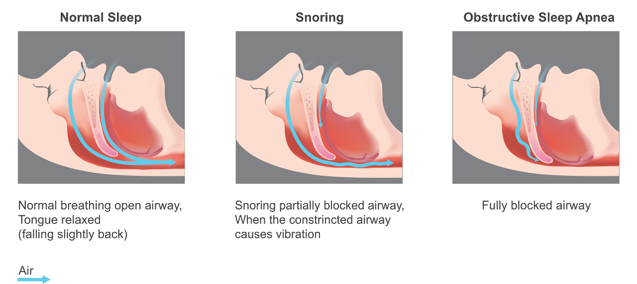 A More Comfortable Way to Stop Snoring - Bethel Gentle Dental